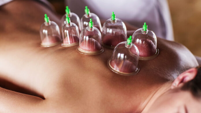 cupping therapy melbourne cupping therapy melbourne