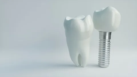 dental implants alexandria