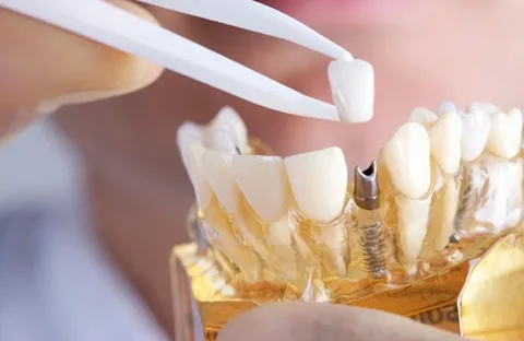 dental implants alexandria dental implants alexandria